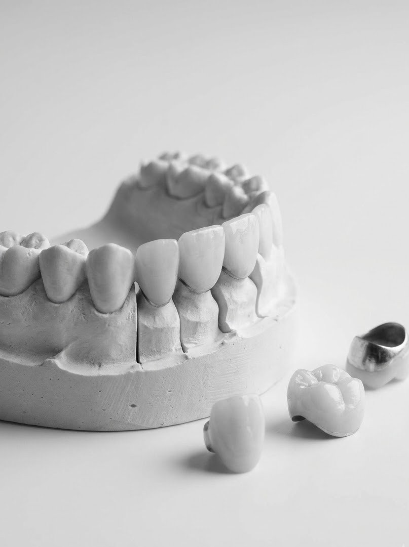 Dental crowns and bridges preparation